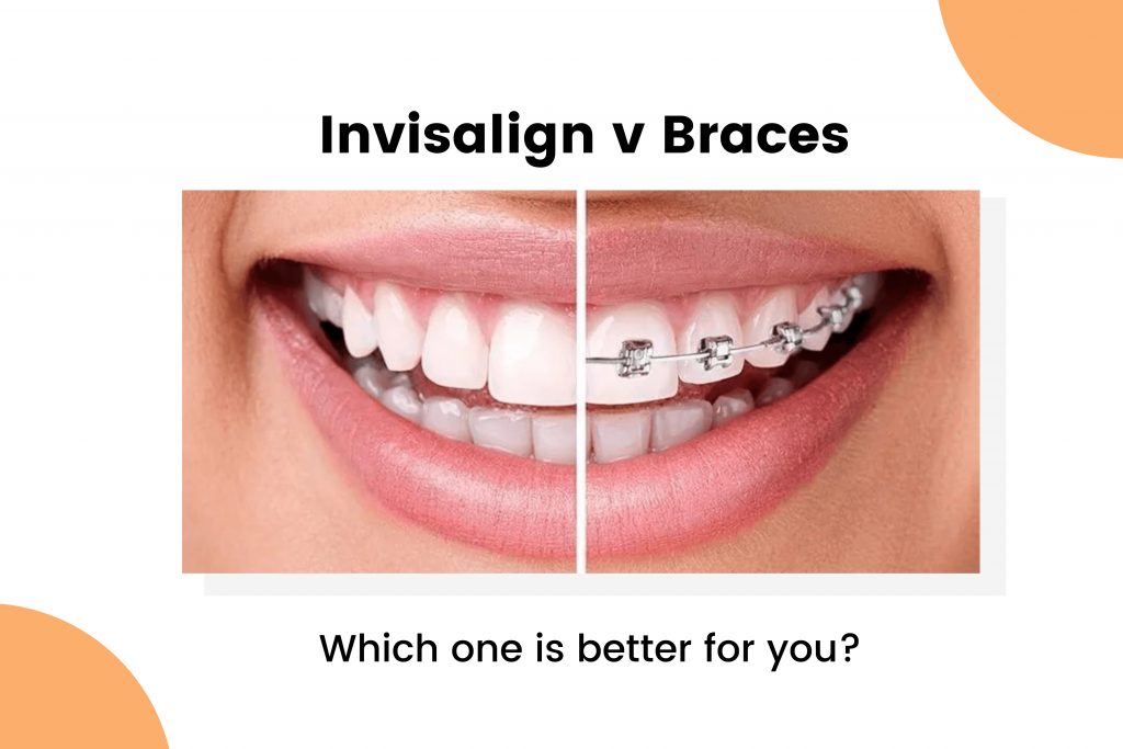 Invisalign vs Braces - which one is better for you?