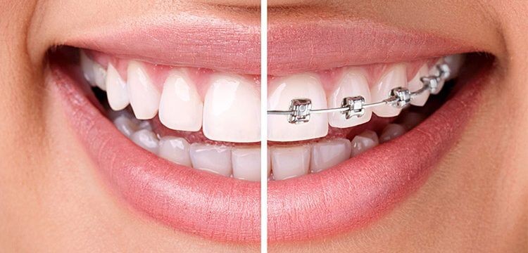 Smiling mouth that is half Invisalign Aligners and half Metal Braces