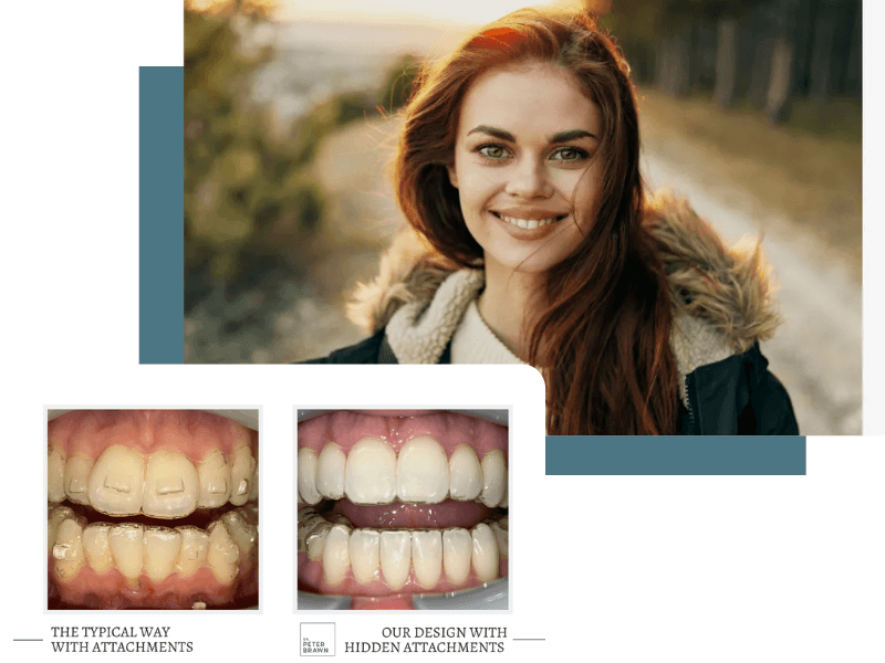 With hidden attachments, your aligners are nearly invisible