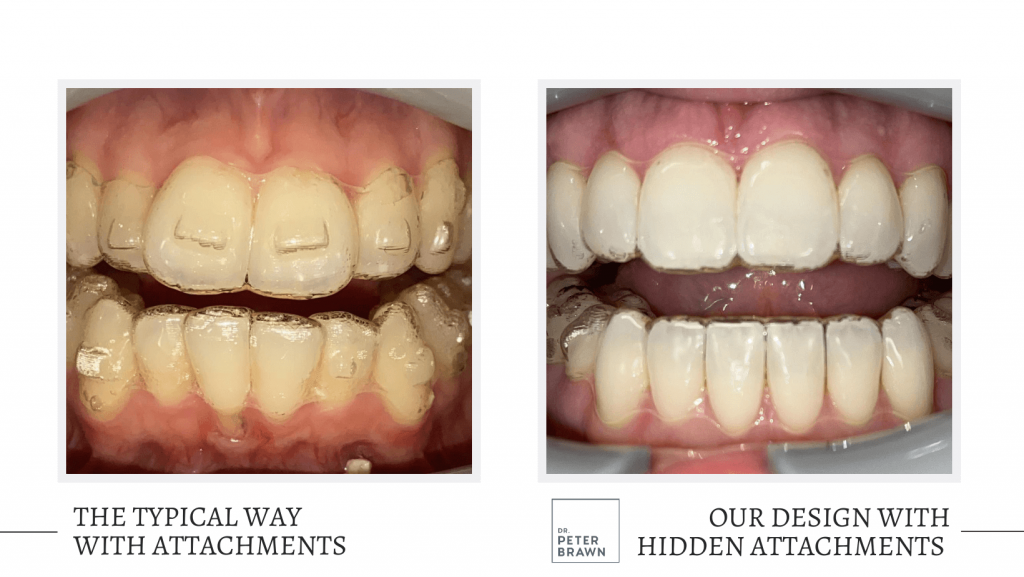 Hidden Invisalign Attachments at Dr. Peter Brawn vs. the Typical Way