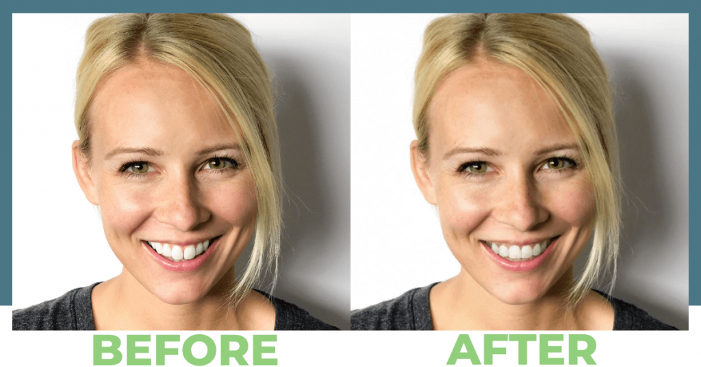 Before and after Straight Teeth With Invisalign