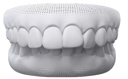 A digital smile with top teeth protruding that needs Invisalign overbite correction