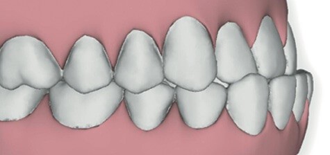 digital rendering of a smile with an underbite, showing the lower jaw and lower teeth protruding 
